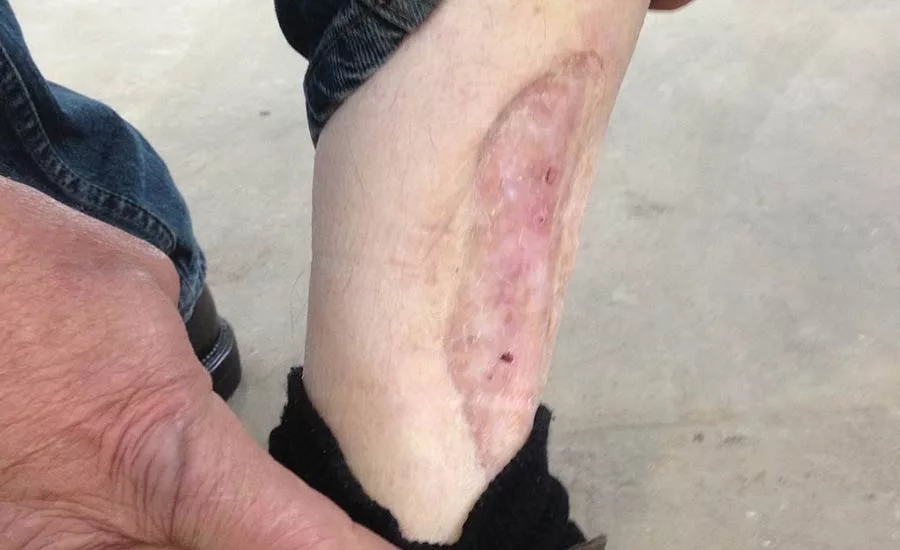 serious injury in the Fall Shadow
